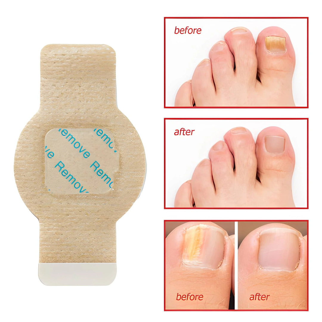 Elaimei™ - Fungal Nail Patches |🔥BUY 1 GET 1 FREE🔥