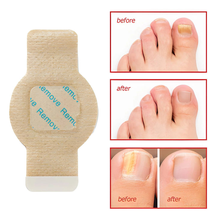 Elaimei™ - Fungal Nail Patches |🔥BUY 1 GET 1 FREE🔥