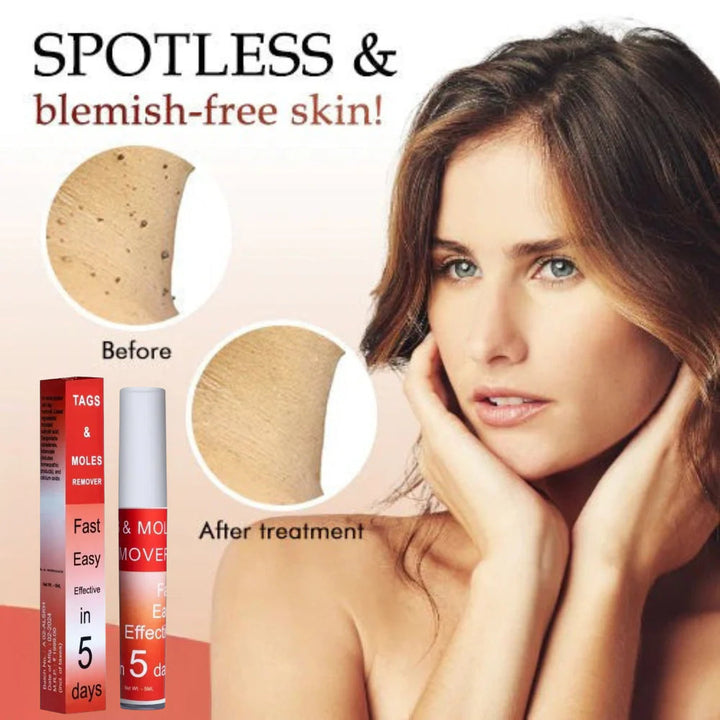 LOVILDS™ Tags &amp; Moles Remover (Buy 1 Get 1 Free🔥🔥)